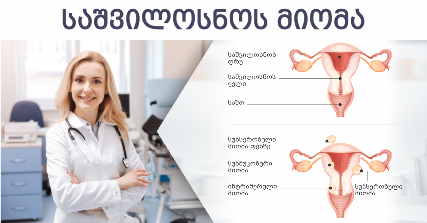 საშვილოსნოს მიომა